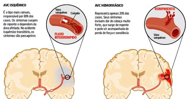 O que é um AVC?
