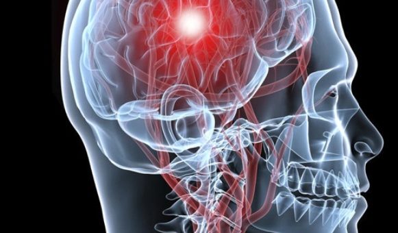 Aneurisma vs Acidente Vascular Cerebral: Quais as diferenças?